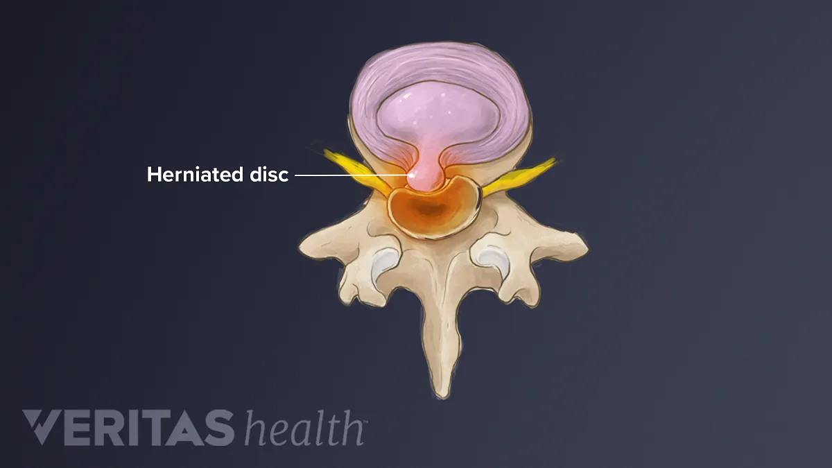 What You Need to Know About Herniated Discs – Centers for Artificial Disc